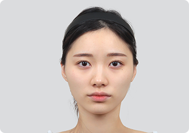 Before facial contour