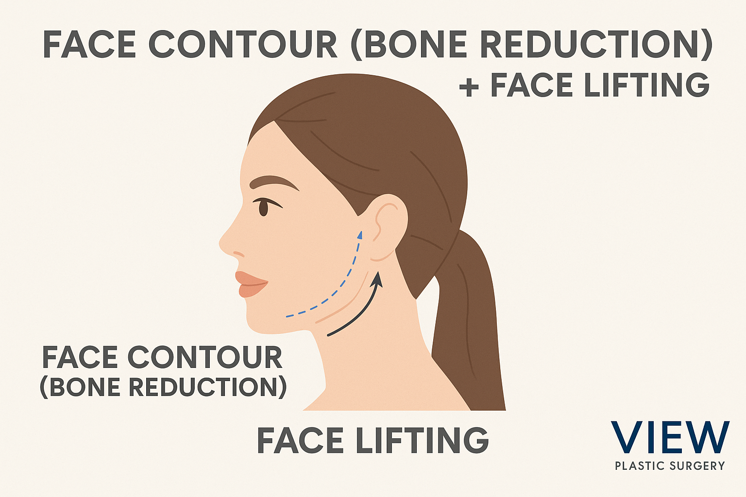 How to Prevent Sagging After Facial Contouring Surgery with a Facelift or Thread Lift in Korea