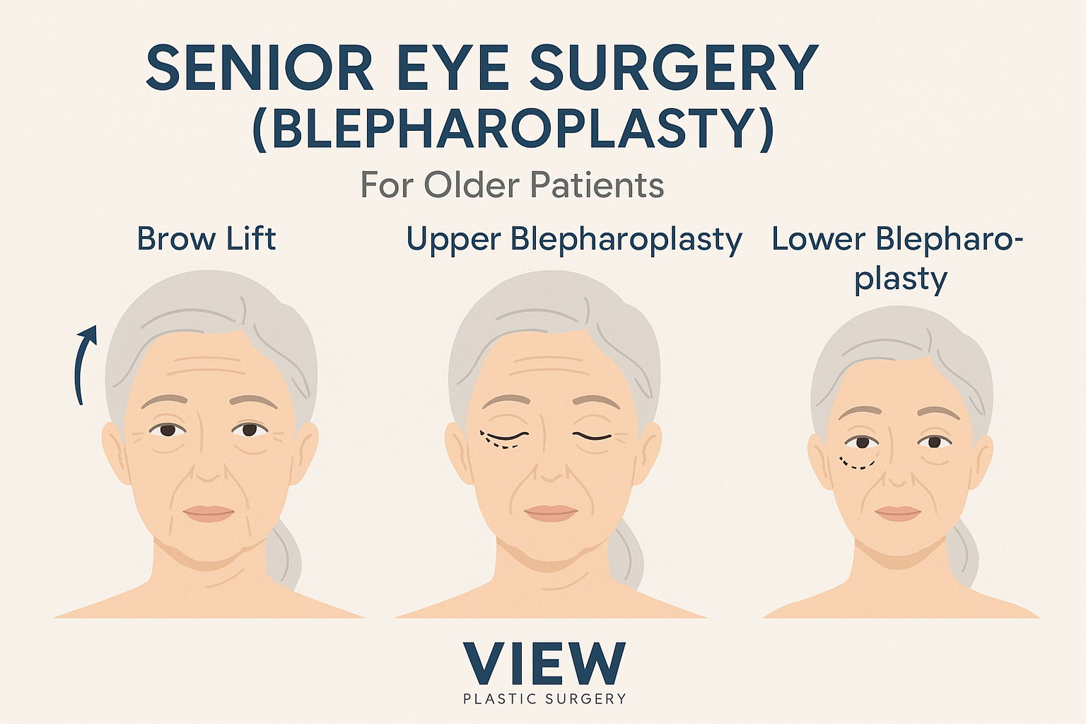 Looking Tired? Maybe It’s Not the Lack of Sleep: Senior Eye Surgery (Blepharoplasty)