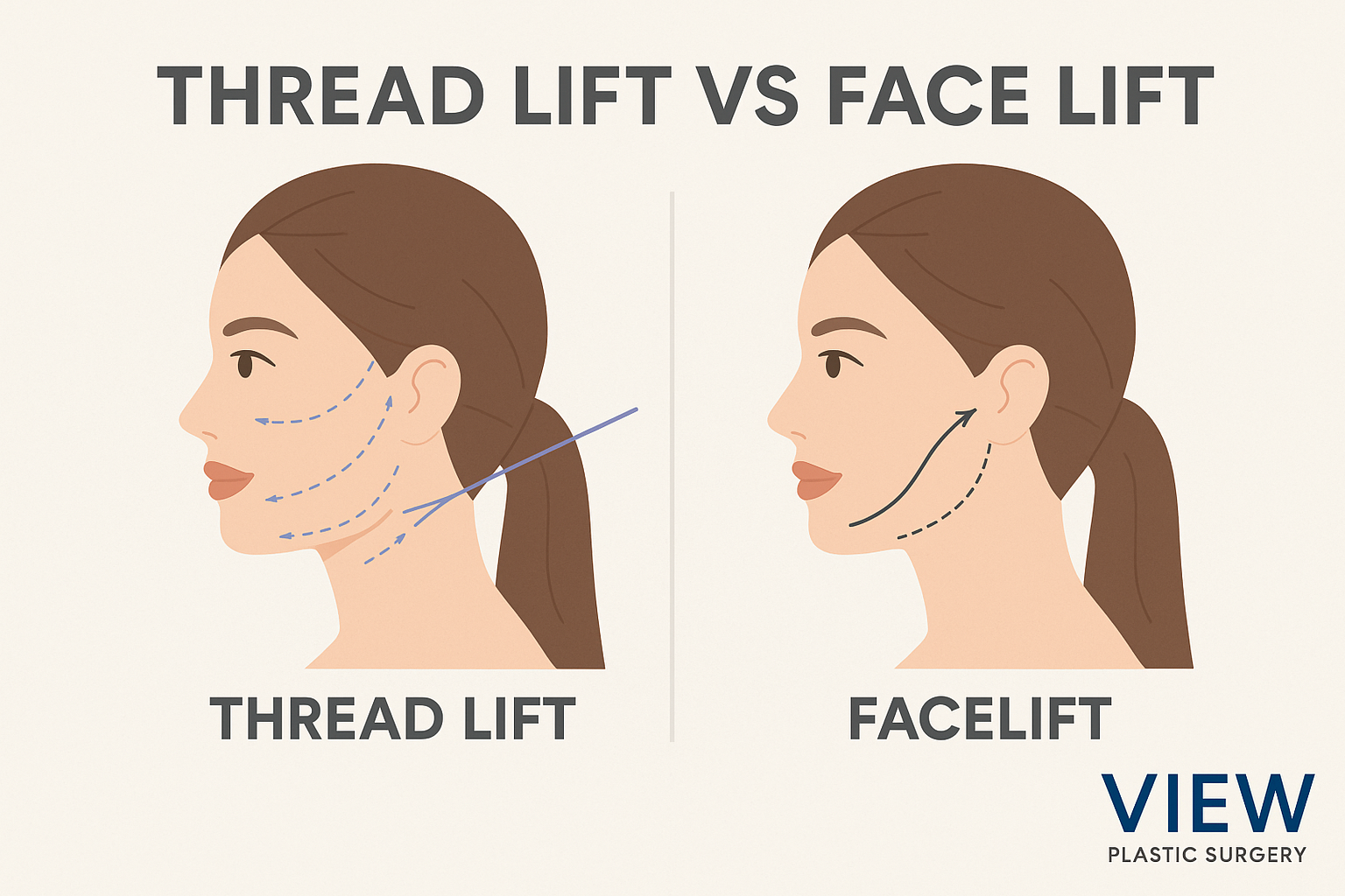 Thread Lift vs. Facelift in Korea: Which Anti-Aging Surgery Is Right for You?