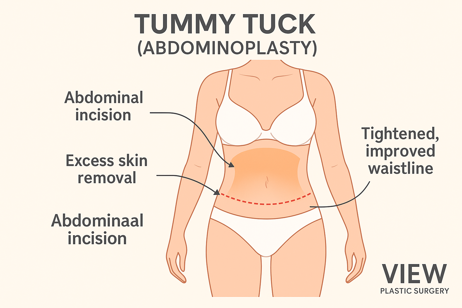 What to Expect from a Tummy Tuck (Abdominoplasty): Procedure, Benefits & Recovery Tips
