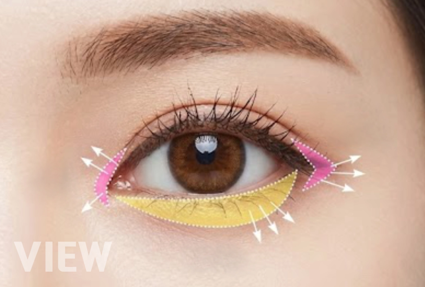 Lateral Canthoplasty, Epicanthoplasty​, Lower Canthoplasty​:Differences, Effects, and Who Needs It
