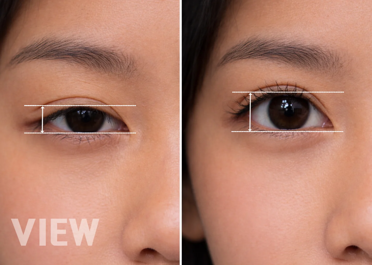 Ptosis Correction : Benefits, Self-Check, and Recovery Guide