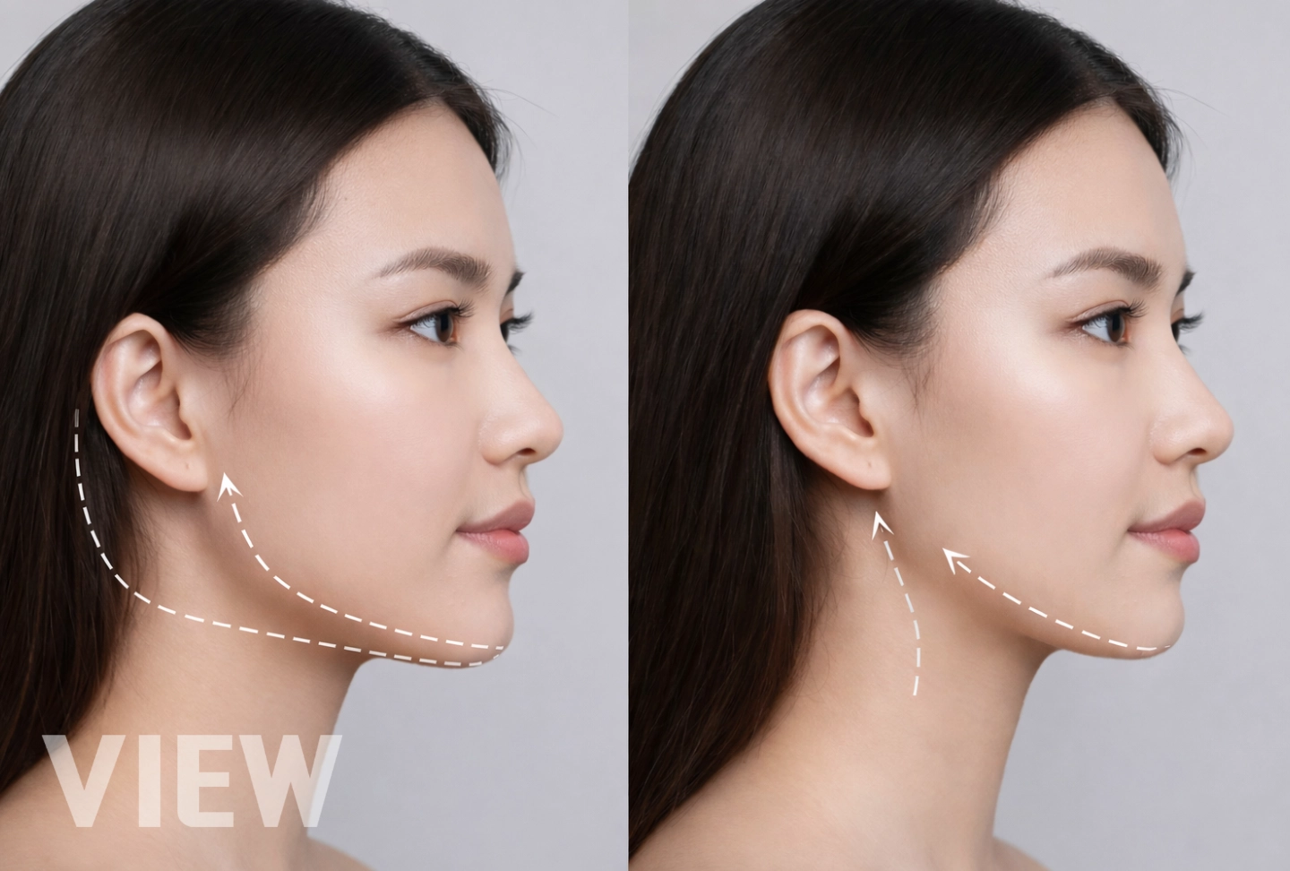 Facial Contouring in Korea: How It Works and What to Expect
