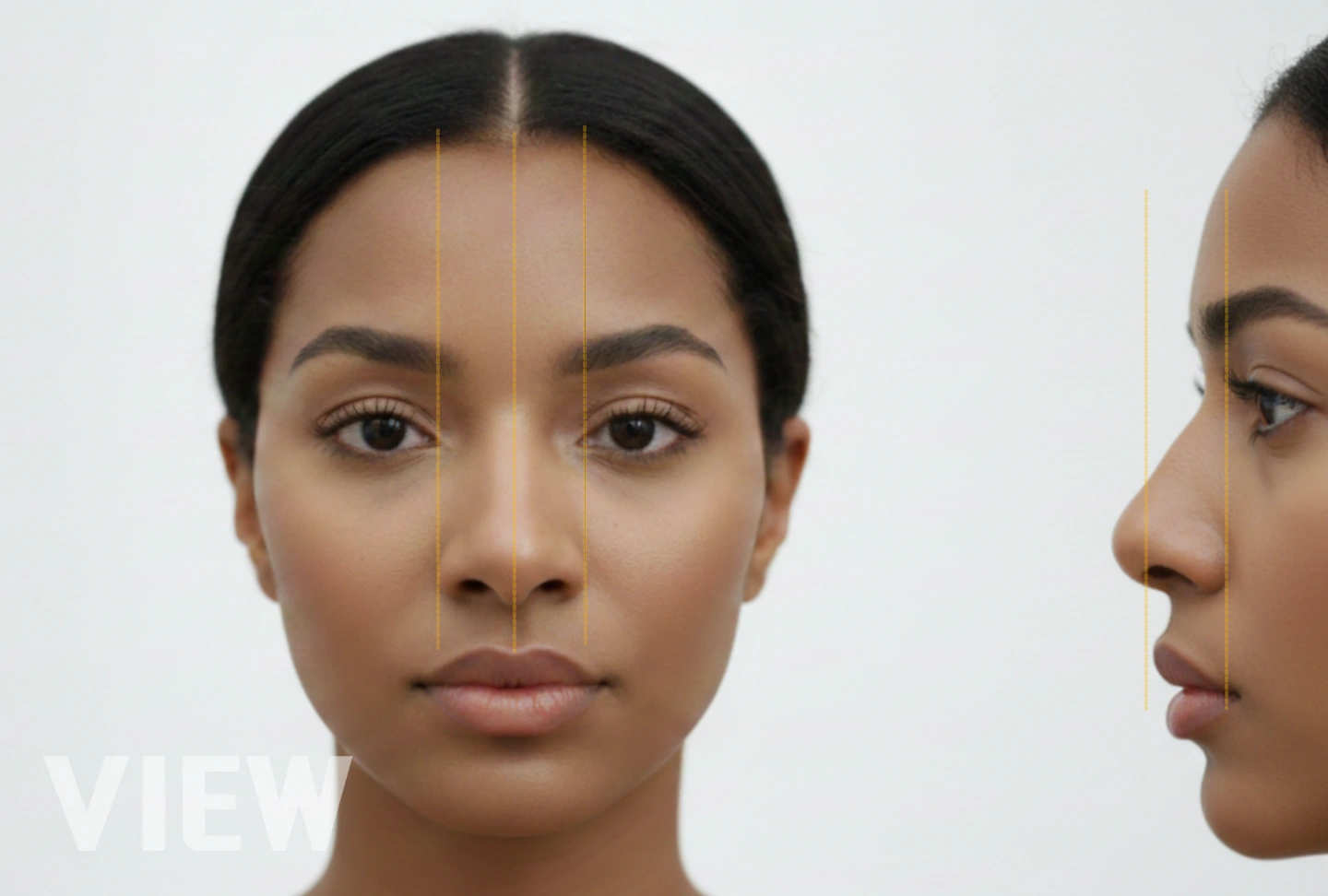 Alar Reduction Only: Why Many Foreigners Skip Full Rhinoplasty in Korea