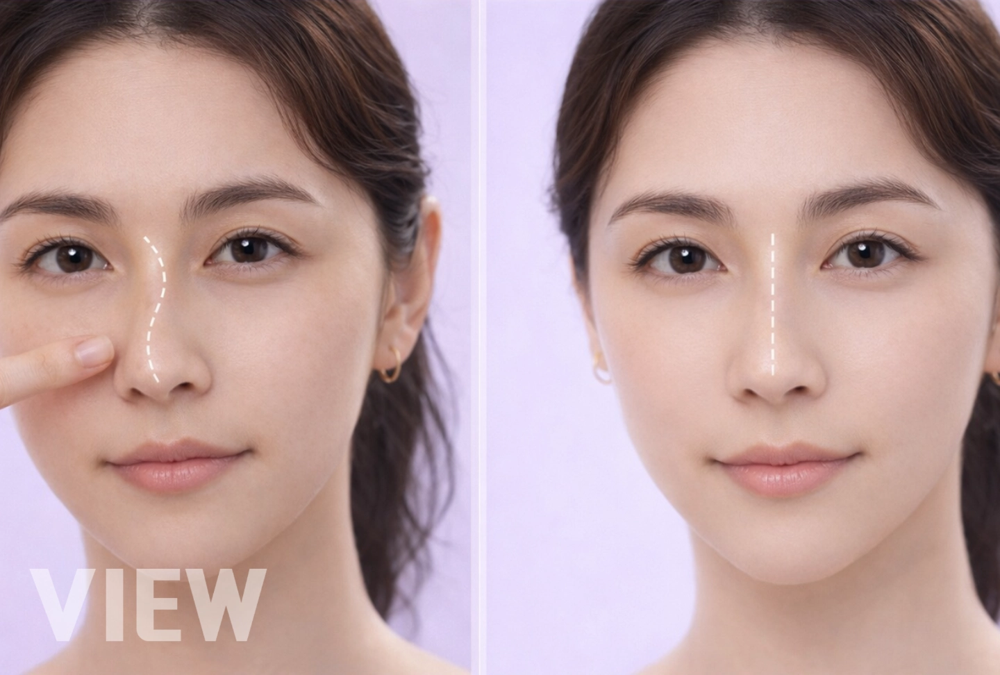 How to Fix My Extremely Crooked Nose? The Ultimate Solution: Functional Rhinoplasty