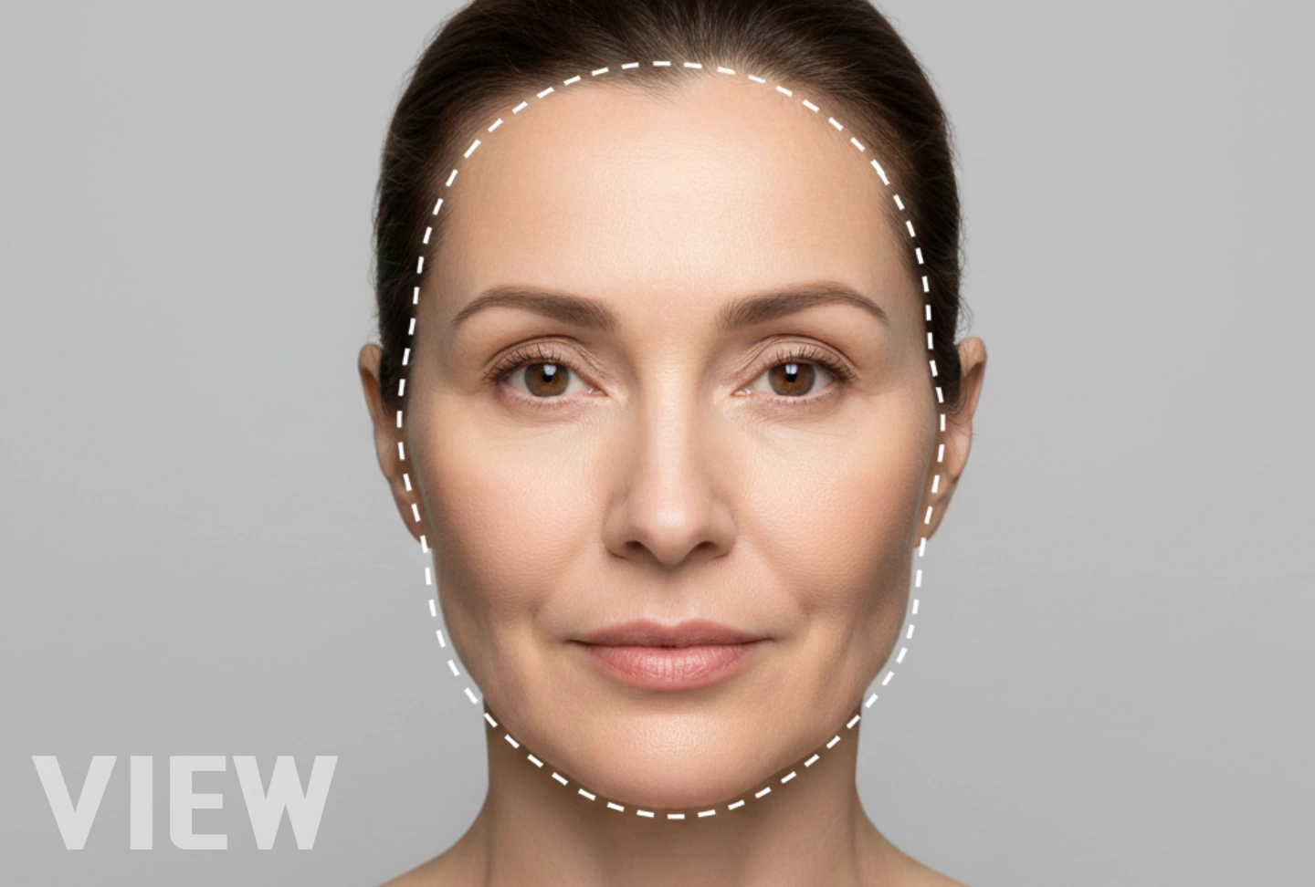 Fixing a Peanut Shaped Face: Midface Rejuvenation with Fat & Stem Cells