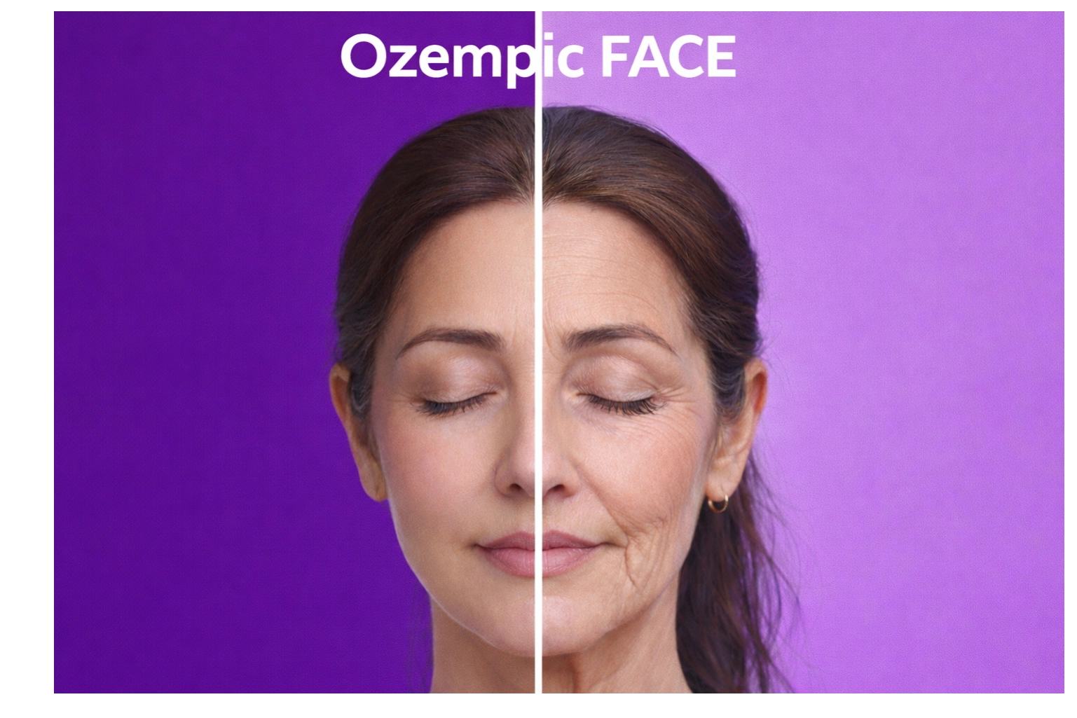 Ozempic Face Correction with Fat Grafting