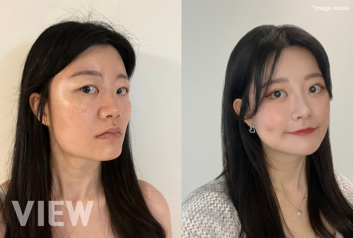 Why Square Jaw Surgery Often Comes Before Full Facial Contouring