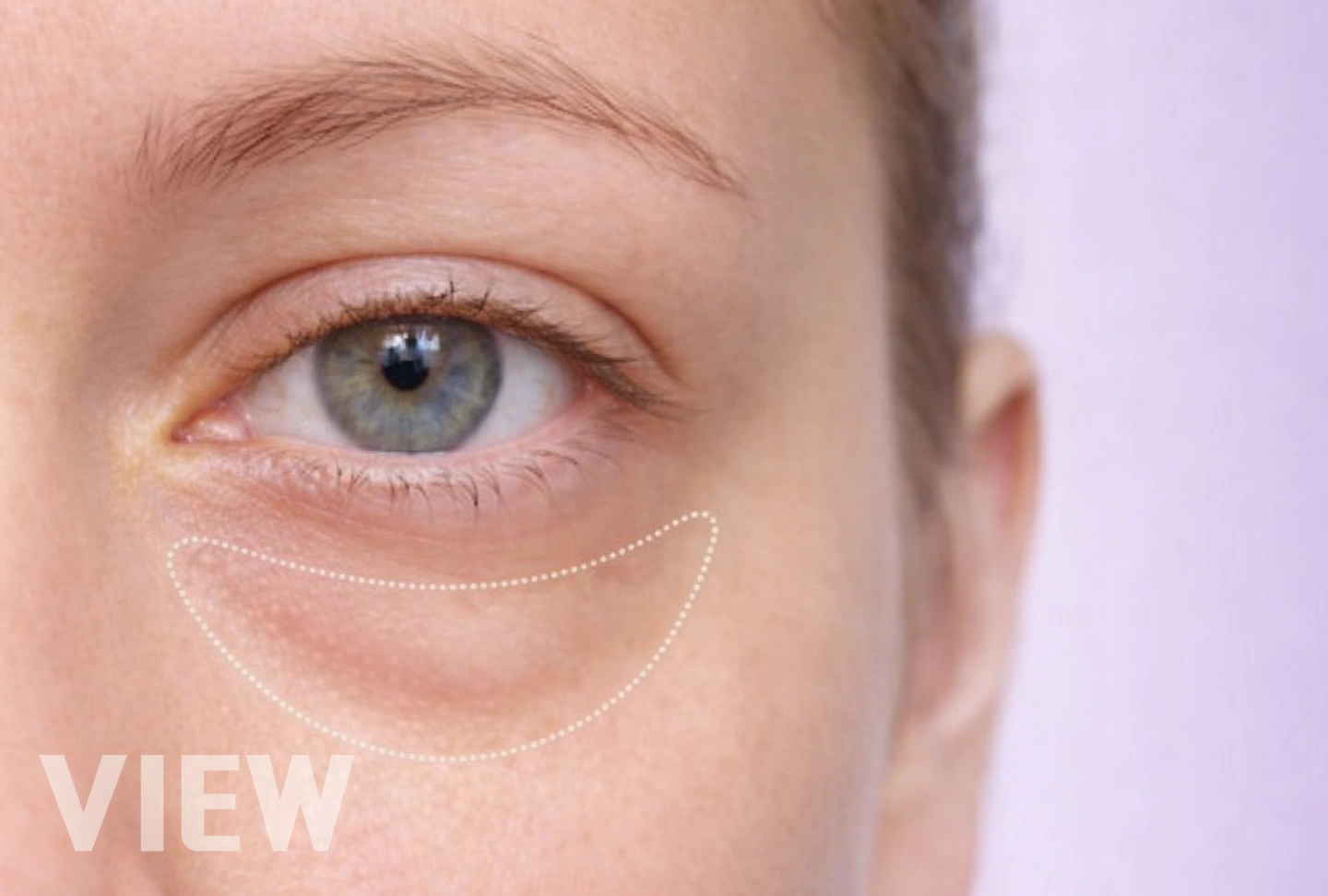 Look 10 Years Younger with Under Eye Surgery: The Secret Behind Eye Bag Surgery in Korea