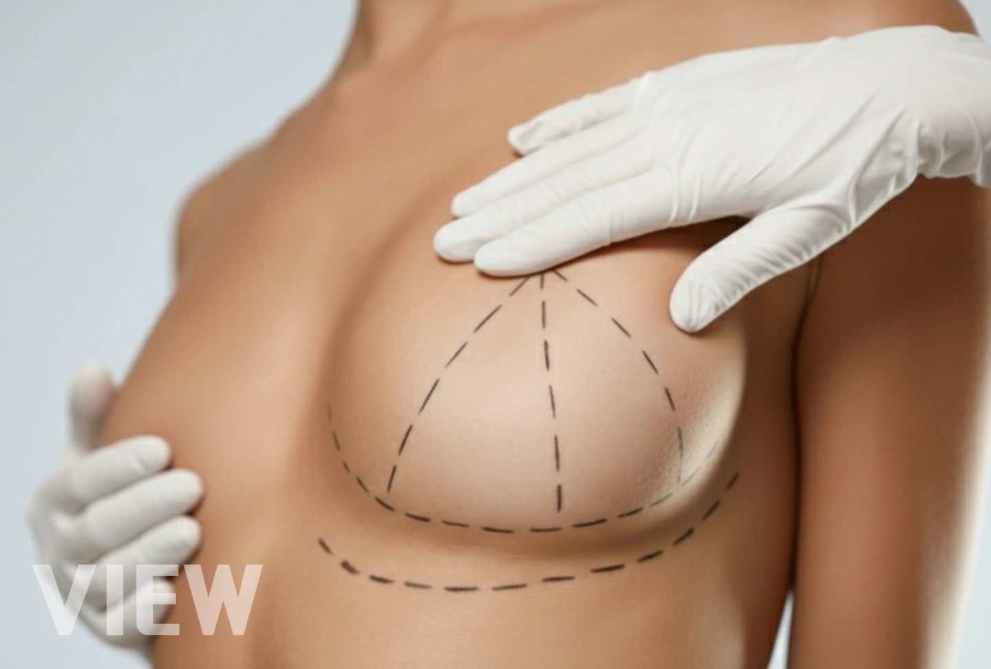 When Breast Implants Are Not Enough: Why You Might Need a Breast Lift Too