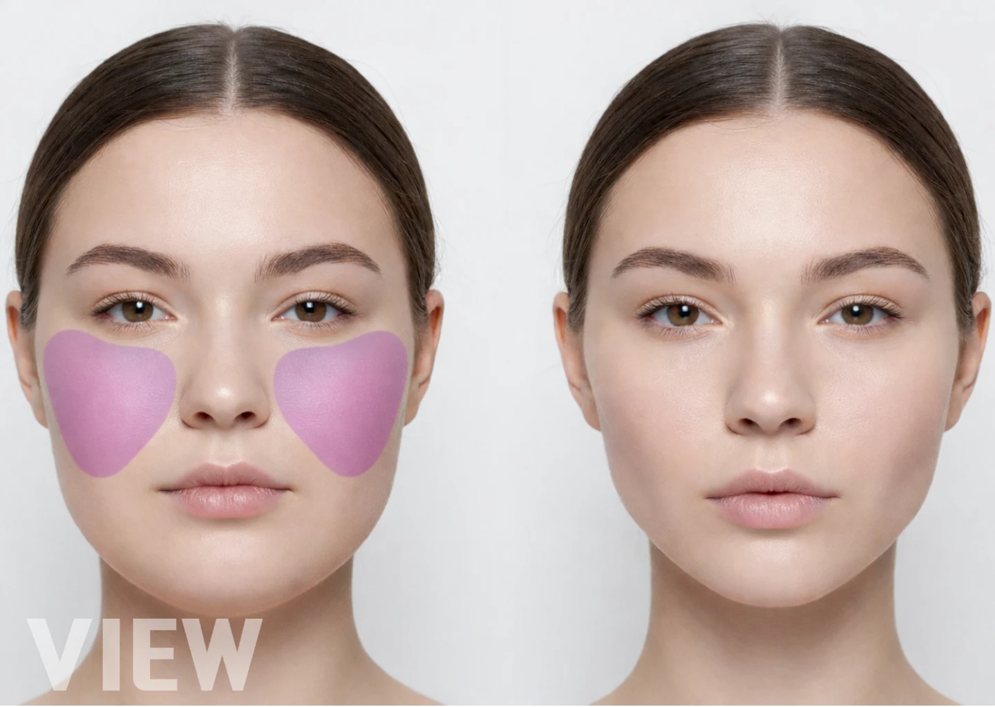 Buccal Fat Removal : Celebrity Trend vs. The Risk of Aging (Anatomy Guide)