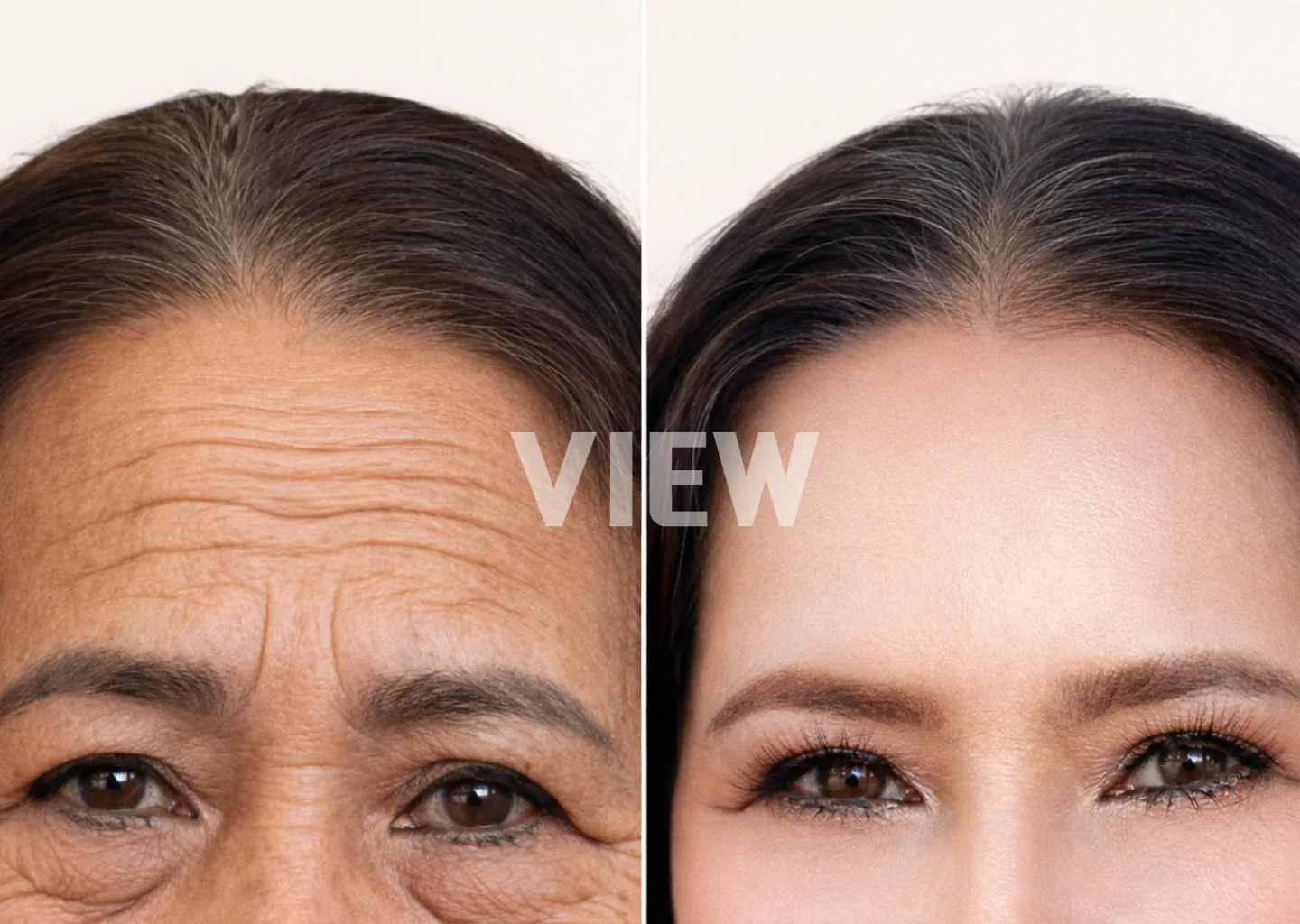 Endotine Lift Korea: Is It Worth the Cost? Results vs. Thread Lift & Facelift