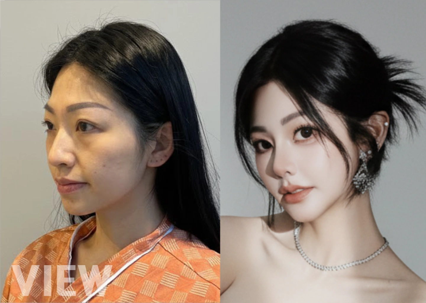 Primary Rhinoplasty in Seoul: What International Patients Should Know