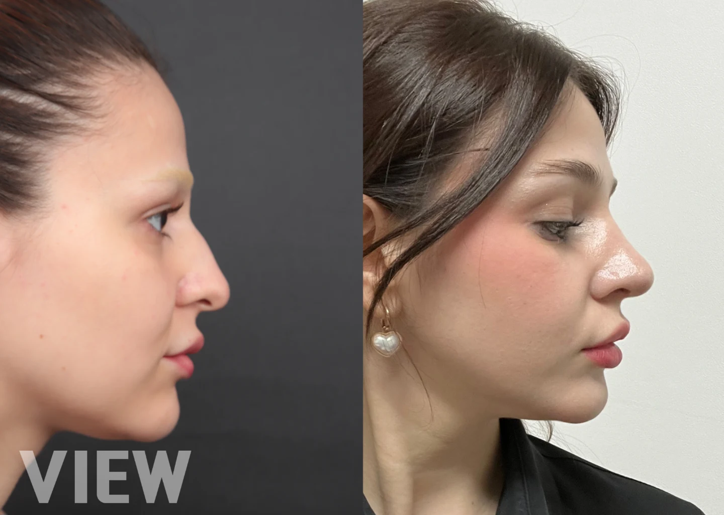 Rhinoplasty Before and After in Seoul: Realistic Expectations