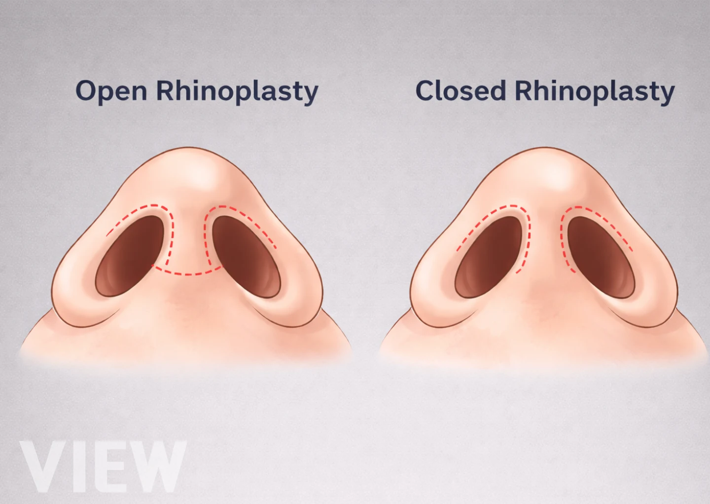 Closed vs Open Rhinoplasty in Seoul: Which Is Better?