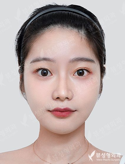Facial Contouring 01 — After