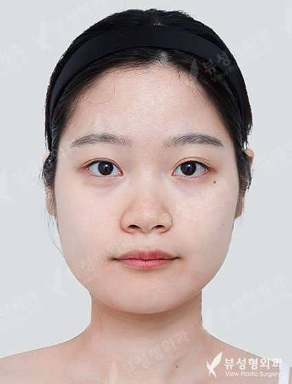 Facial Contouring 01 — Before