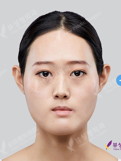 Two Jaw+3 Types Face Contouring +(3 Months) — Before