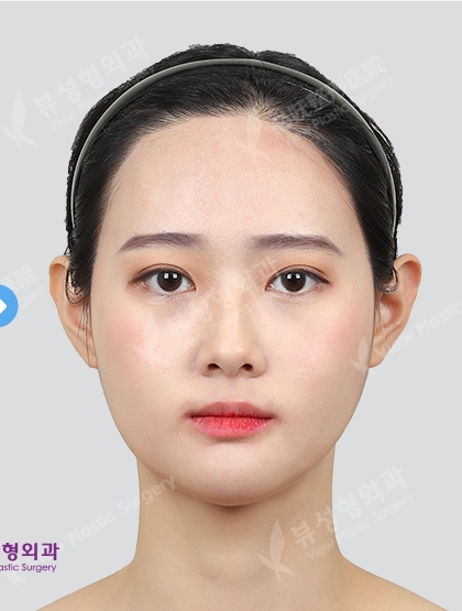 Two Jaw+3 Types Face Contouring +(3 Months) — After