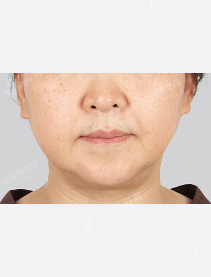 Toning + Vita 10 times (1 month) — Before