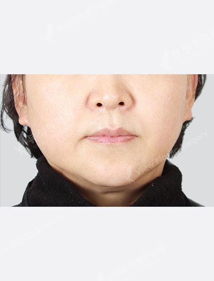 Toning + Vita 10 times (1 month) — After