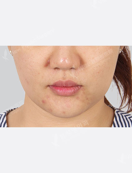 Line Cell (1 month) — Before