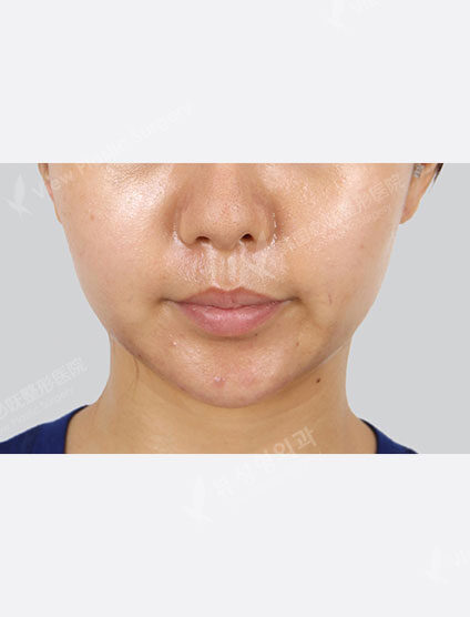 Ultra Skin (1 month) — Before