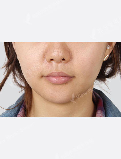 Ultra Skin (1 month) — After