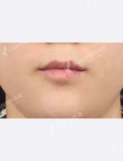 Lip Botox + Lip Filler (1 month) — Before