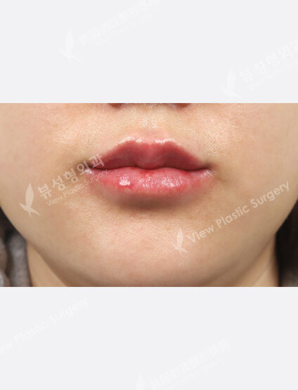 Lip Botox + Lip Filler (1 month) — After