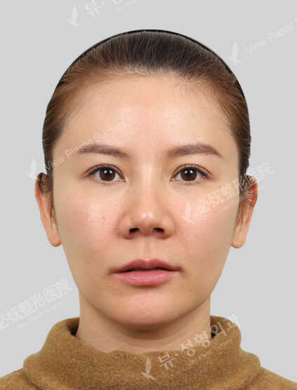 Vivace+pdrn+Rejuran Healer (1 month) — Before