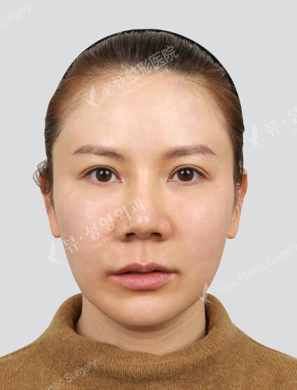 Vivace+pdrn+Rejuran Healer (1 month) — After