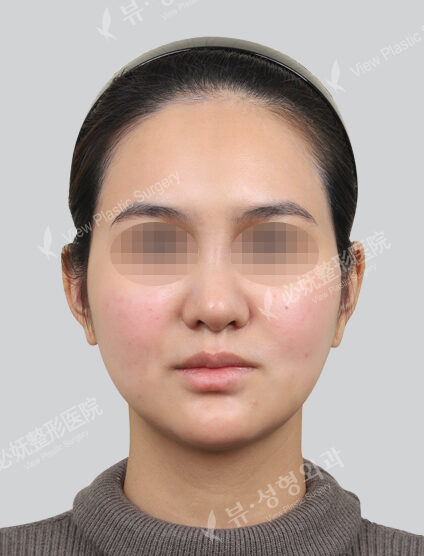 Rejuran Healer + Shrink + Contouring Injection (Neck and Chin) (1 month) — Before