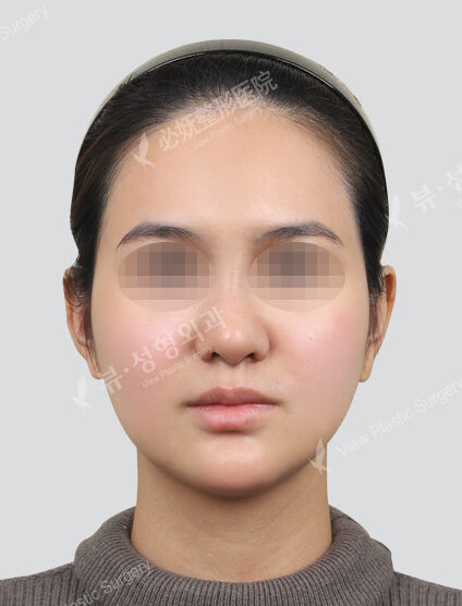 Rejuran Healer + Shrink + Contouring Injection (Neck and Chin) (1 month) — After
