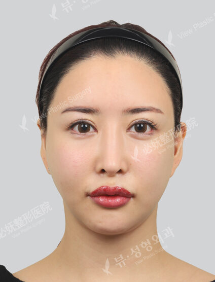 Chanel Injection + Cinderella Injection (1 month) — Before
