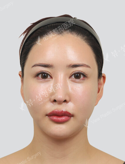 Chanel Injection + Cinderella Injection (1 month) — After