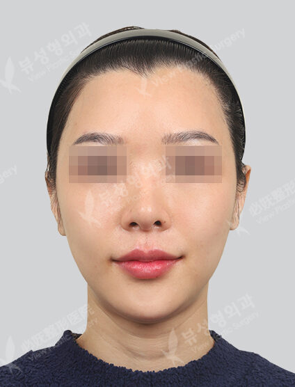 Rejuran Healer 4cc + Cinderella Injection (1 month) — Before