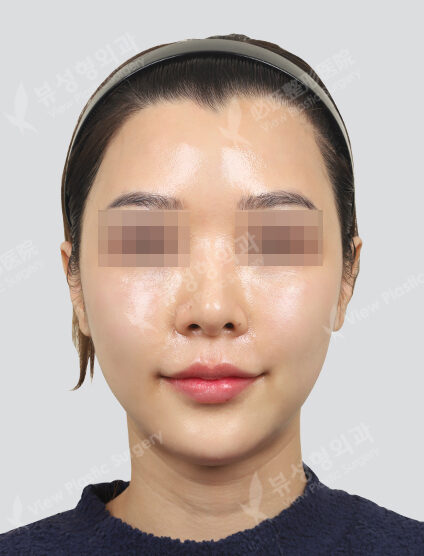 Rejuran Healer 4cc + Cinderella Injection (1 month) — After