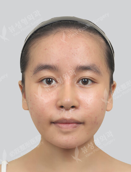 2 soft pills + 1 Fraxel (1 month) — Before