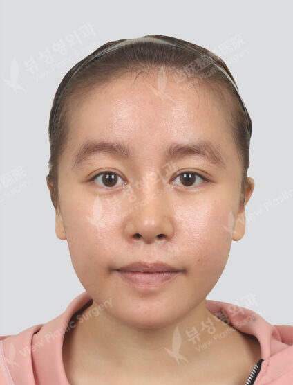2 soft pills + 1 Fraxel (1 month) — After