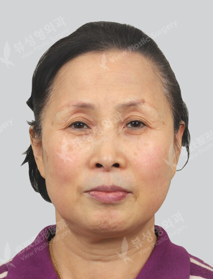 ipl 3 times + toning 7 times + ruby ​​touch + co2 (1 month) — Before