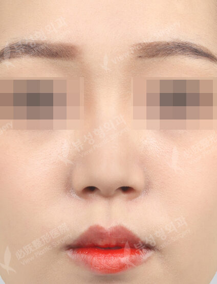 Nose filler (1 month) — Before