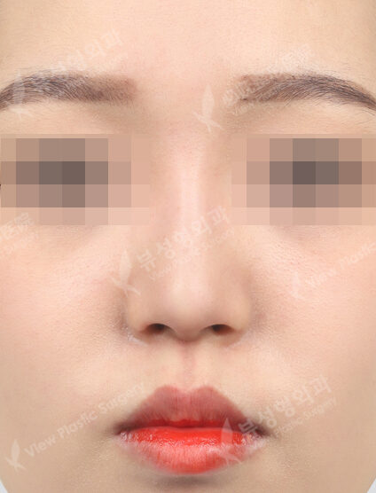 Nose filler (1 month) — After