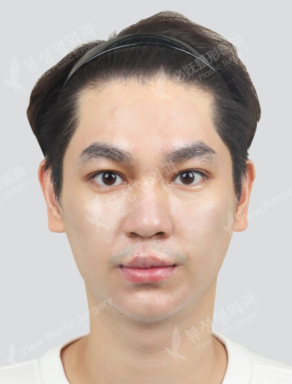 Fraxel 1 time + Rejuran Healer 1 time (1 month) — After