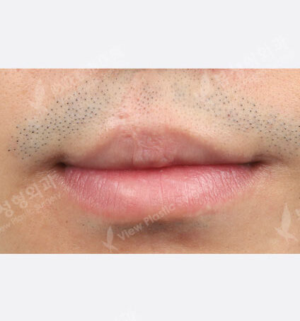 Lip filler (1 month) — Before