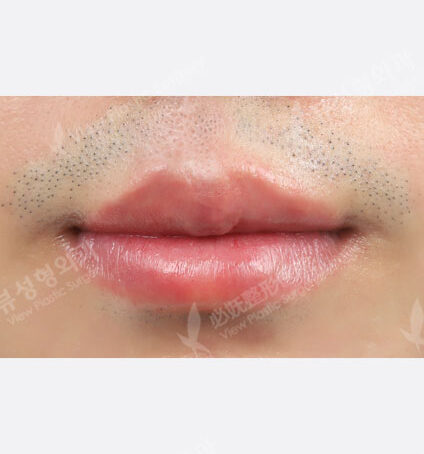 Lip filler (1 month) — After