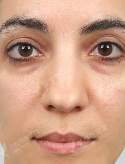 Fraxel, CO2 point removal (1 month) — Before