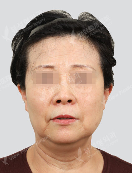 Toning 7 times + HIP + ruby ​​touch + ND Yag 3 times (1 month) — After