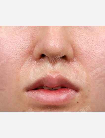 Rejuran Healer + Chin Filler (1 month) — Before